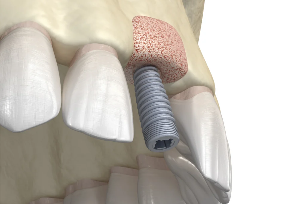 greffe osseuse implant greffe osseuse implant Greffe osseuse pré-implantaire Dr Mehdi HALLOUL, chirurgien-dentiste à Rouen