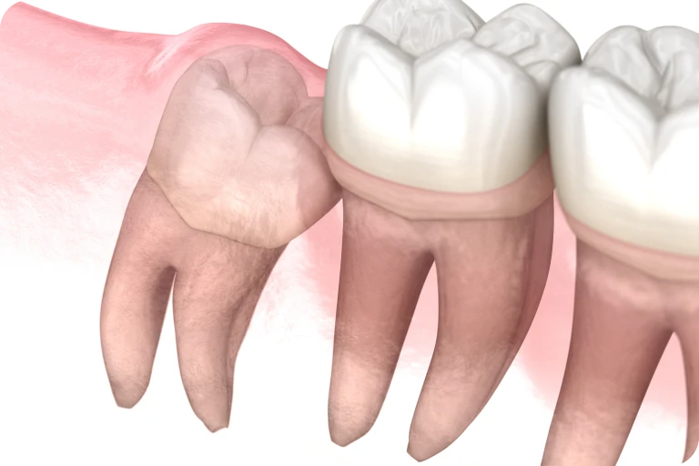 chirurgie dent incluse docteur halloul rouen Chirurgie des dents incluses Dr Mehdi HALLOUL, chirurgien-dentiste à Rouen