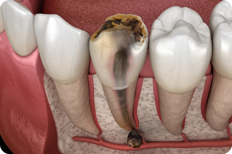 chirurgie kyste dentaire docteur halloul rouen Kystes dentaires et lésions péri-apicales Dr Mehdi HALLOUL, chirurgien-dentiste à Rouen
