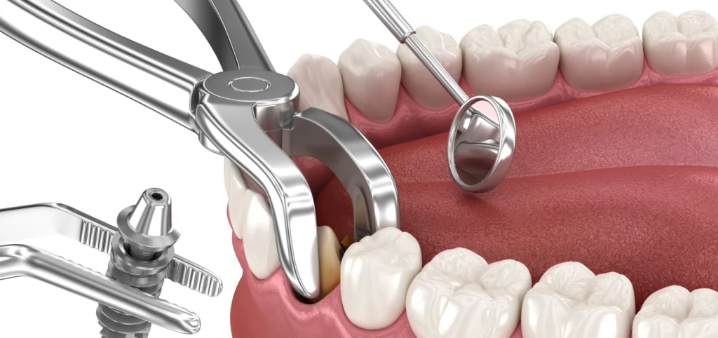 extraction implantation rouen extraction implantation rouen Protocoles de mise en charge immédiate Dr Mehdi HALLOUL, chirurgien-dentiste à Rouen