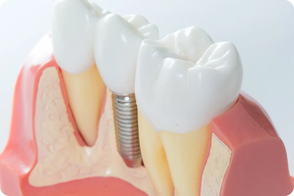 implant dentaire rouen FAQ implants dentaires Dr Mehdi HALLOUL, chirurgien-dentiste à Rouen