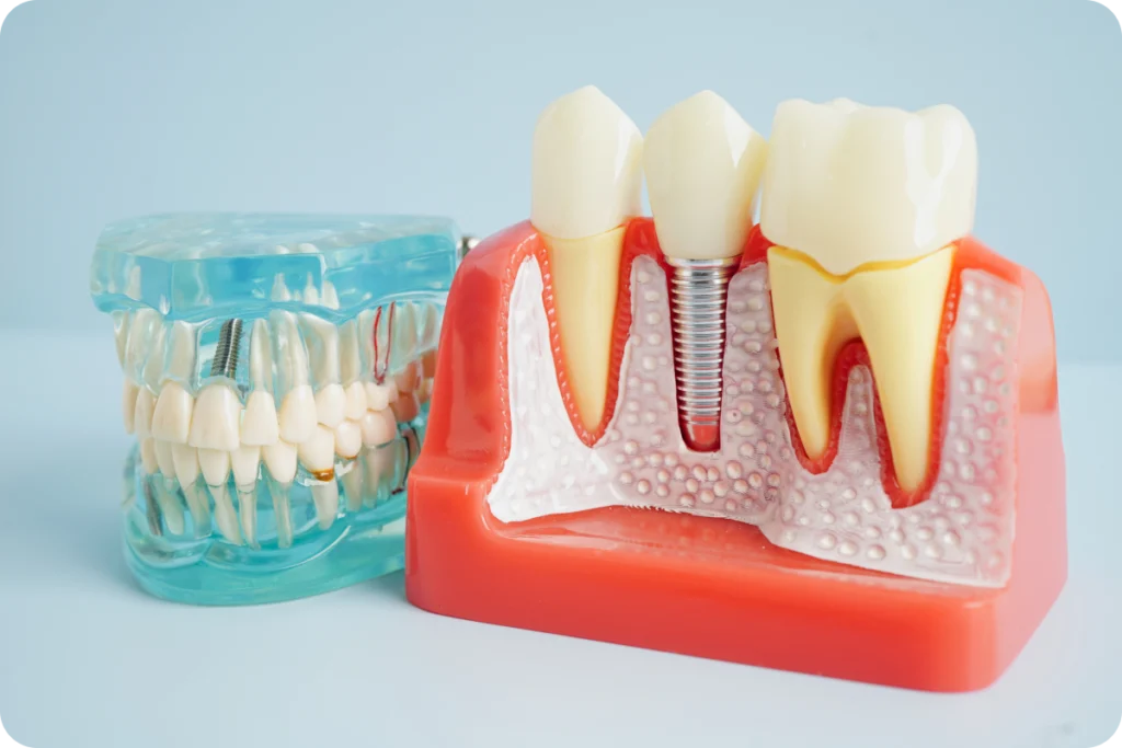 rouen consultation dentiste implant dentaire FAQ implants dentaires Dr Mehdi HALLOUL, chirurgien-dentiste à Rouen