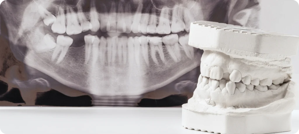 rouen dentiste implant dentaire Pose d'implants dentaires Dr Mehdi HALLOUL, chirurgien-dentiste à Rouen