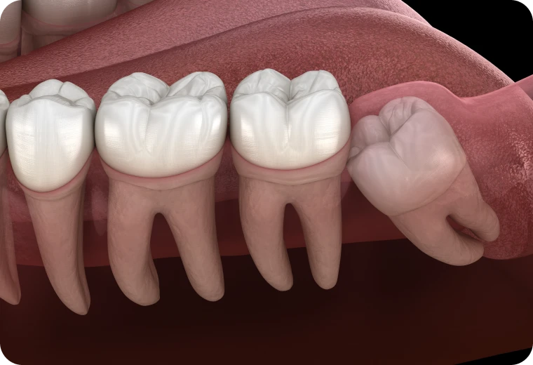 Illustration 3D d'une dent incluse dans la mâchoire