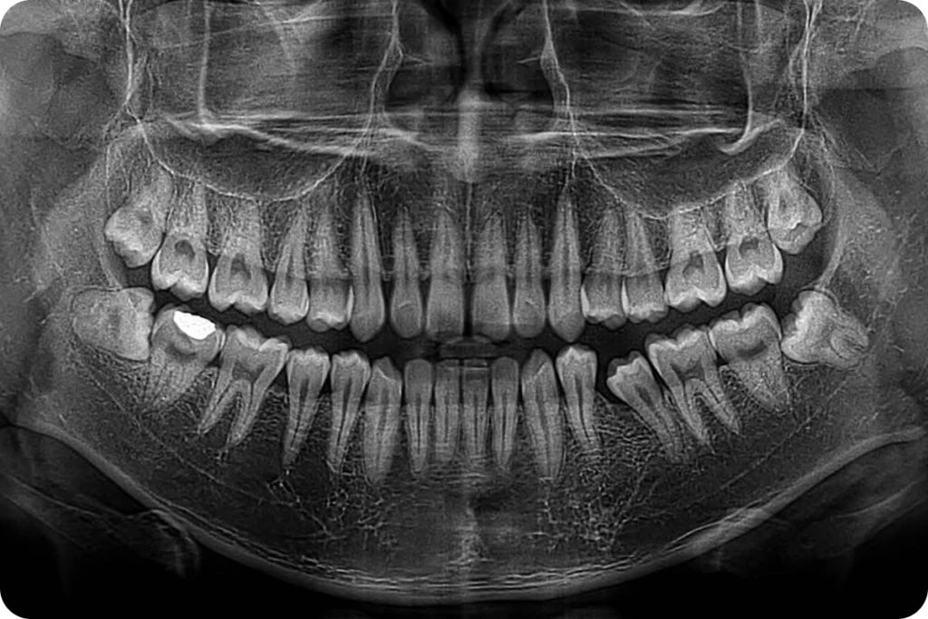 Suites opératoires après extraction de dents de sagesse